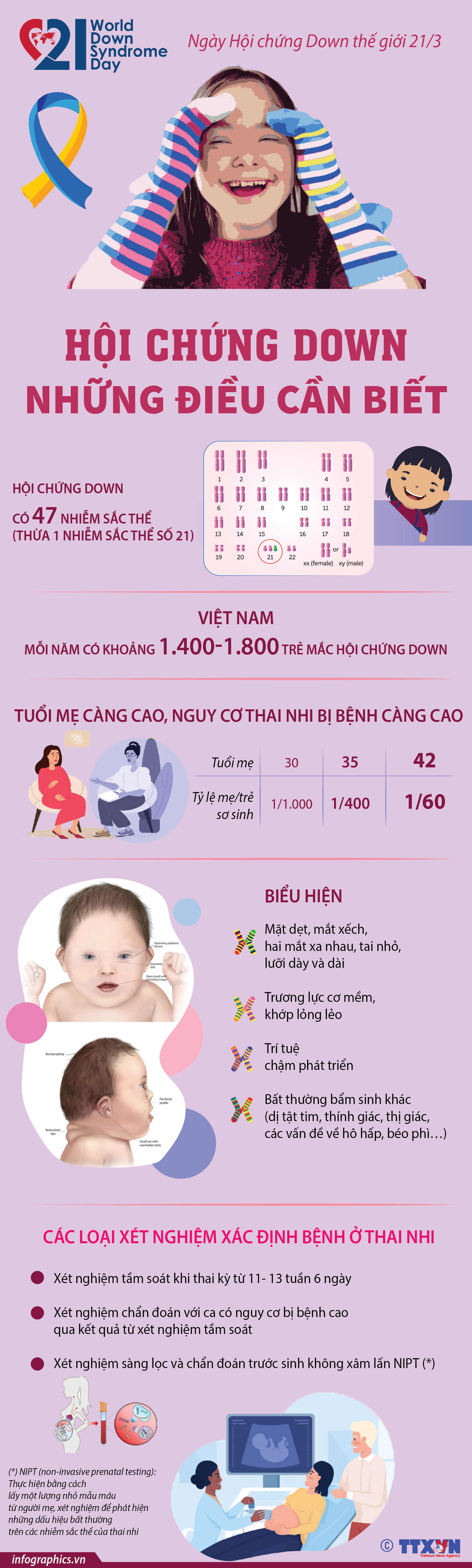 Ngày Hội chứng Down thế giới 21/3: Hội chứng Down: Những điều cần biết
